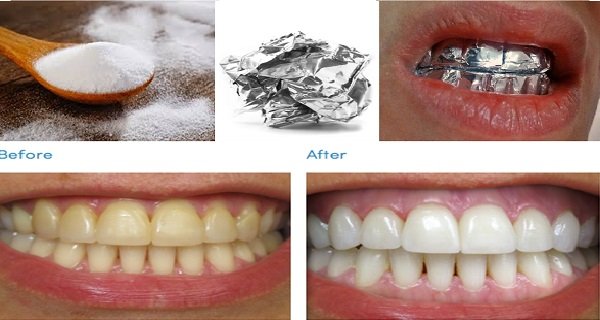 سفید کردن دندان با فویل آلومینیوم